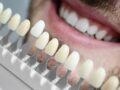 Getting Dental Veneers