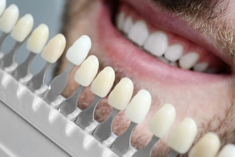 Getting Dental Veneers